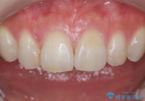 ナイトガードで歯ぎしり予防の治療前