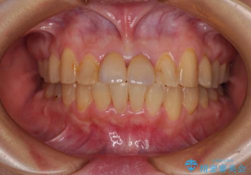 前歯のデコボコをワイヤー矯正できれいに整えるの症例 治療後