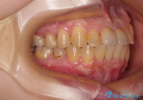 前歯のデコボコをワイヤー矯正できれいに整えるの治療後