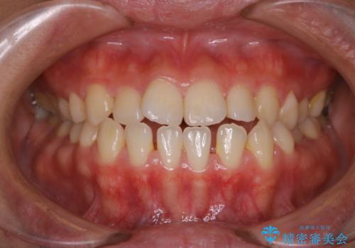 歯茎が薄い方へのインビザライン治療、歯肉退縮予防の症例 治療前