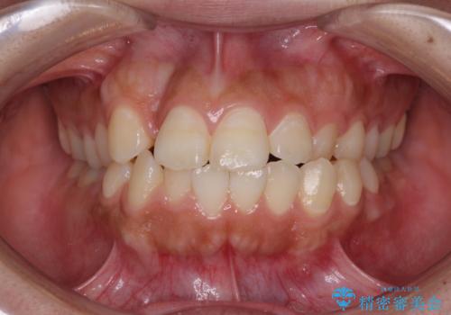 急速拡大とワイヤー抜歯矯正で唇を閉じやすくの症例 治療前
