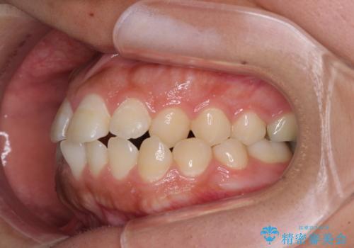 急速拡大とワイヤー抜歯矯正で唇を閉じやすくの治療前