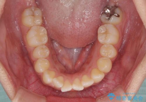急速拡大とワイヤー抜歯矯正で唇を閉じやすくの治療前