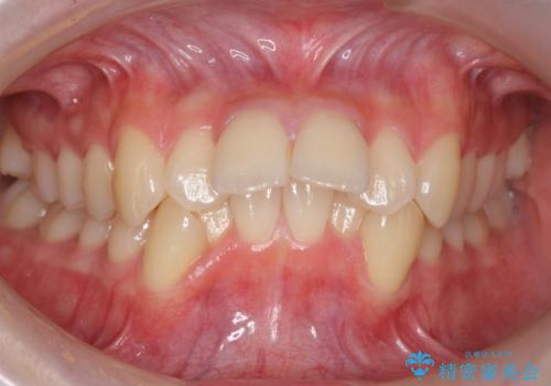 他3軒で4本抜いてワイヤー矯正と言われた　1本の抜歯でマウスピース矯正で治療可能ですの症例 治療前