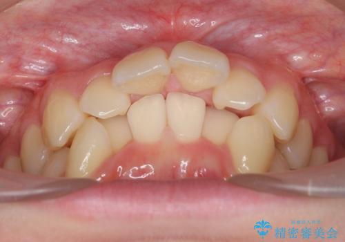 他3軒で4本抜いてワイヤー矯正と言われた 1本の抜歯でマウスピース矯正で治療可能ですの治療前