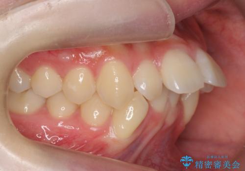 他3軒で4本抜いてワイヤー矯正と言われた 1本の抜歯でマウスピース矯正で治療可能ですの治療前