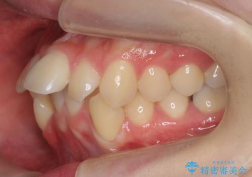 他3軒で4本抜いてワイヤー矯正と言われた 1本の抜歯でマウスピース矯正で治療可能ですの治療前