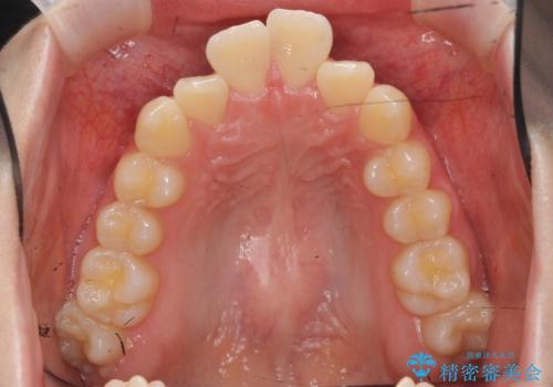 他3軒で4本抜いてワイヤー矯正と言われた 1本の抜歯でマウスピース矯正で治療可能ですの治療前