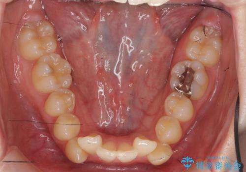 他3軒で4本抜いてワイヤー矯正と言われた 1本の抜歯でマウスピース矯正で治療可能ですの治療前
