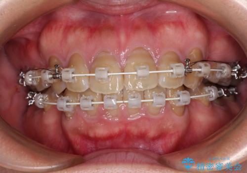 横顔の印象が大きく変わる ワイヤー装置での抜歯矯正の治療中