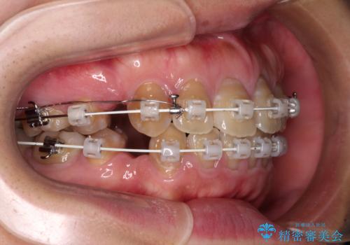 横顔の印象が大きく変わる　ワイヤー装置での抜歯矯正の治療中