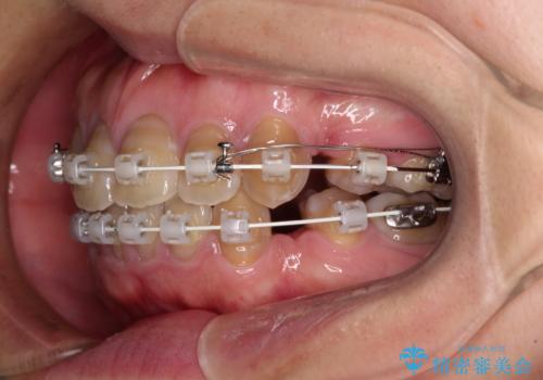 横顔の印象が大きく変わる ワイヤー装置での抜歯矯正の治療中