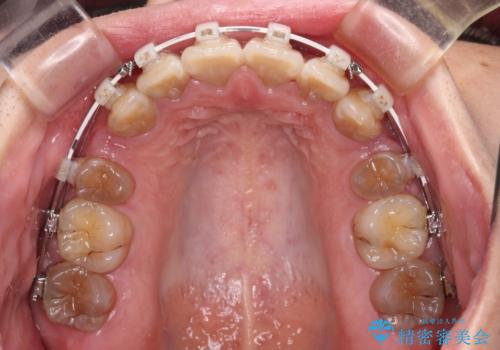 横顔の印象が大きく変わる　ワイヤー装置での抜歯矯正の治療中