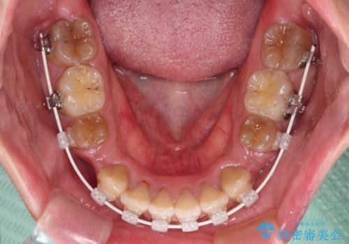 横顔の印象が大きく変わる ワイヤー装置での抜歯矯正の治療中