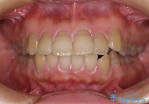 横顔の印象が大きく変わる　ワイヤー装置での抜歯矯正の症例 治療前