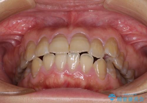 横顔の印象が大きく変わる ワイヤー装置での抜歯矯正の治療前