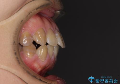 横顔の印象が大きく変わる　ワイヤー装置での抜歯矯正の治療前