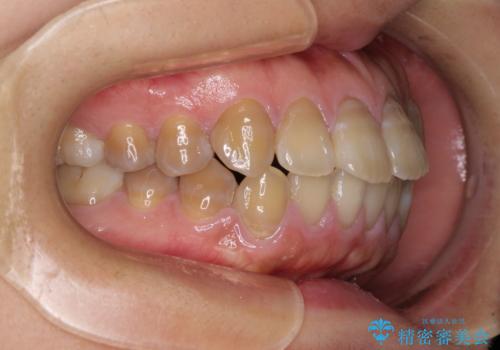 横顔の印象が大きく変わる ワイヤー装置での抜歯矯正の治療前