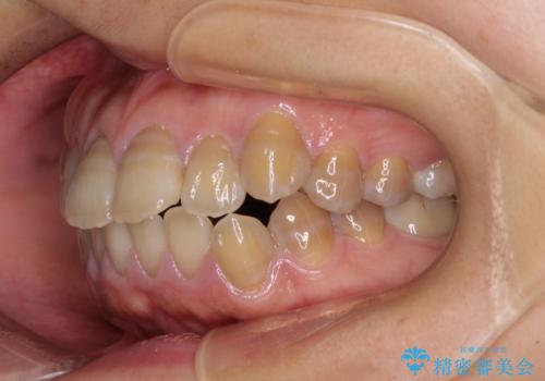 横顔の印象が大きく変わる ワイヤー装置での抜歯矯正の治療前