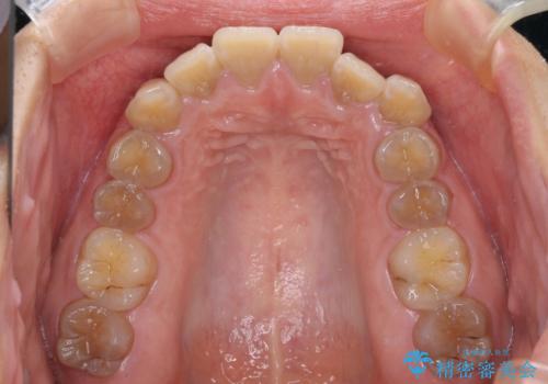 横顔の印象が大きく変わる ワイヤー装置での抜歯矯正の治療前