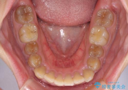 横顔の印象が大きく変わる ワイヤー装置での抜歯矯正の治療前