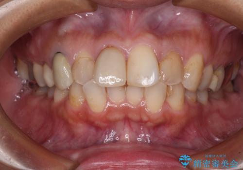 【モニター】処置歯の多い歯列　インビザラインでデコボコを整えるの症例 治療前