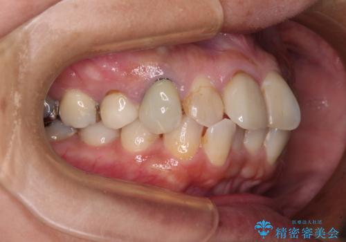 【モニター】処置歯の多い歯列　インビザラインでデコボコを整えるの治療前