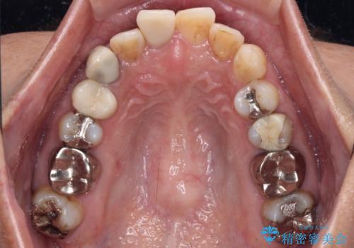 【モニター】処置歯の多い歯列　インビザラインでデコボコを整えるの治療前