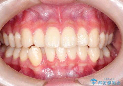 インビザラインによる矯正治療(非抜歯)　前歯の捻れとガタつきの改善の症例 治療前