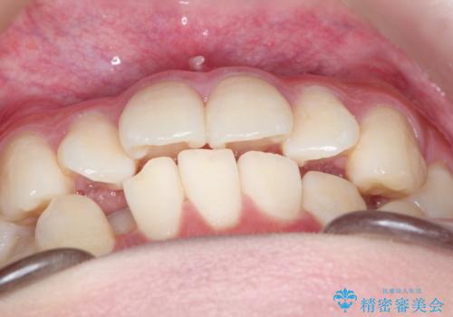 インビザラインによる矯正治療(非抜歯) 前歯の捻れとガタつきの改善の治療前