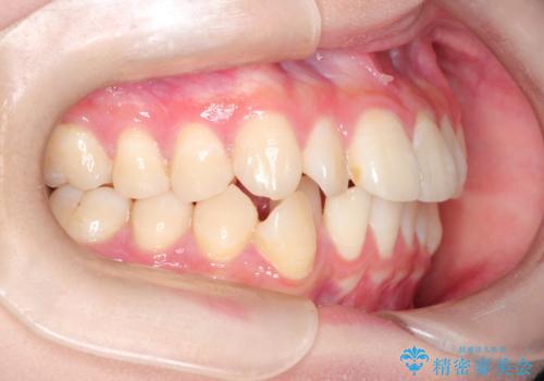 インビザラインによる矯正治療(非抜歯)　前歯の捻れとガタつきの改善の治療前