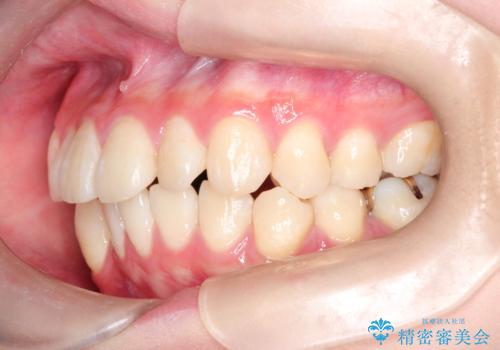 インビザラインによる矯正治療(非抜歯) 前歯の捻れとガタつきの改善の治療前