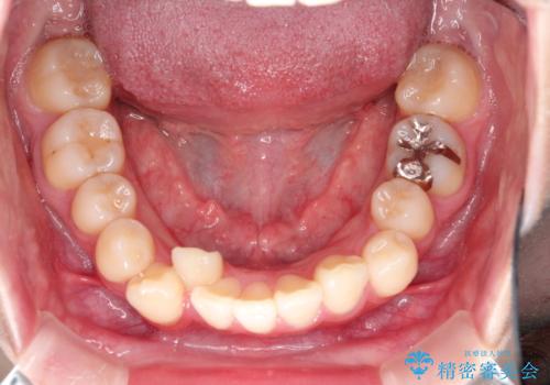 インビザラインによる矯正治療(非抜歯)　前歯の捻れとガタつきの改善の治療前