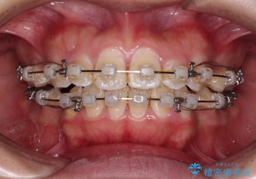 口が閉じにくい ワイヤー装置での抜歯矯正の治療中