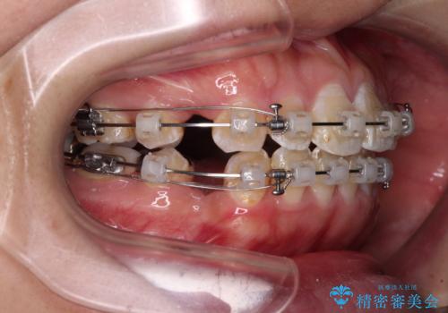 口が閉じにくい ワイヤー装置での抜歯矯正の治療中