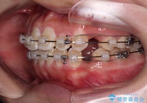 口が閉じにくい ワイヤー装置での抜歯矯正の治療中