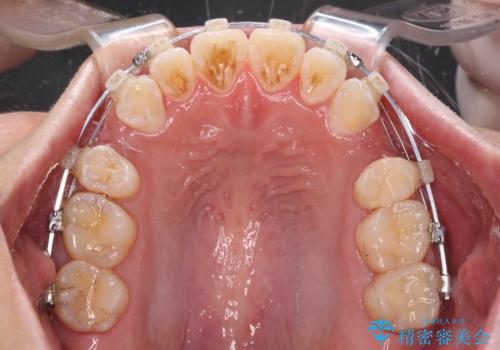 口が閉じにくい ワイヤー装置での抜歯矯正の治療中