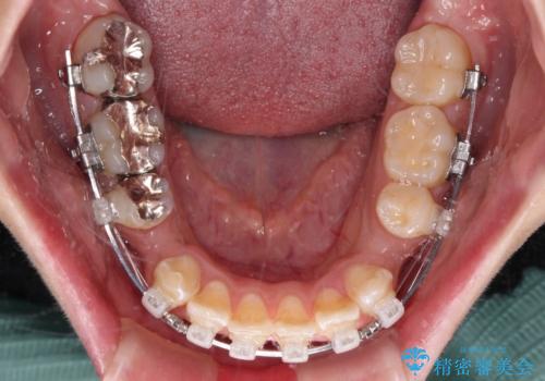 口が閉じにくい　ワイヤー装置での抜歯矯正の治療中