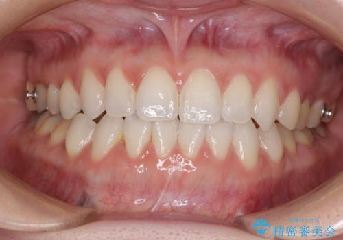 前歯のデコボコをすっきりと インビザライン矯正の治療中