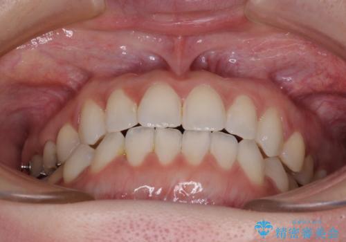 前歯のデコボコをすっきりと インビザライン矯正の治療中