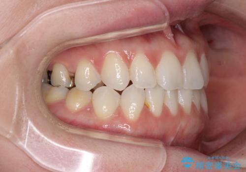 前歯のデコボコをすっきりと インビザライン矯正の治療中