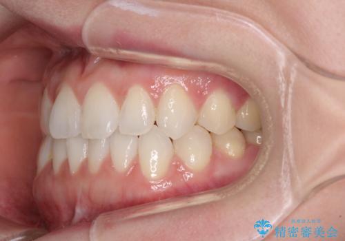 前歯のデコボコをすっきりと インビザライン矯正の治療中