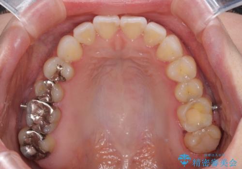 前歯のデコボコをすっきりと インビザライン矯正の治療中