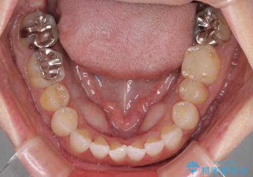 前歯のデコボコをすっきりと インビザライン矯正の治療中