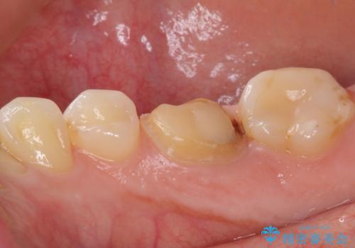 クラウンが外れたままの奥歯 オールセラミッククラウン補綴治療の治療前