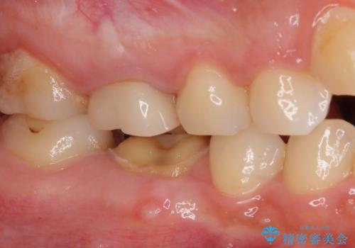 クラウンが外れたままの奥歯 オールセラミッククラウン補綴治療の治療前