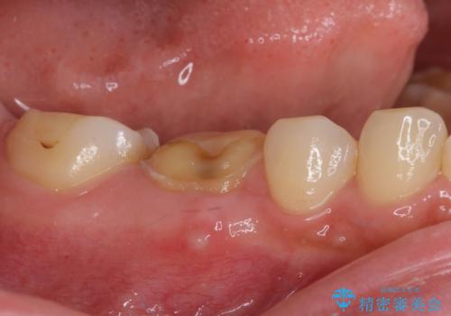 クラウンが外れたままの奥歯 オールセラミッククラウン補綴治療の治療前