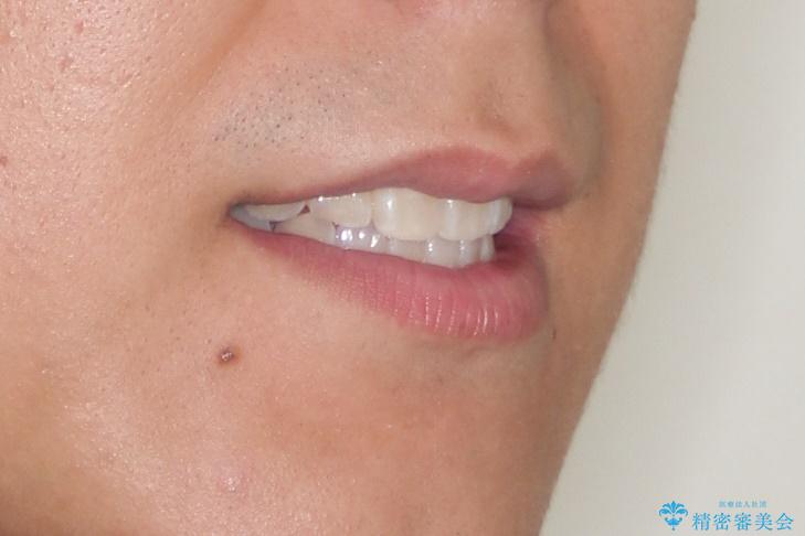 マウスピース矯正で素敵な笑顔に変身!前歯のガタツキを治しましたの治療後(顔貌)