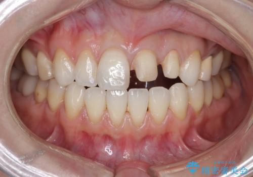 【オールセラミッククラウン】前歯の色が気になる!　左右で歯の長さが違うの治療中