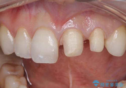 【オールセラミッククラウン】前歯の色が気になる! 左右で歯の長さが違うの治療中
